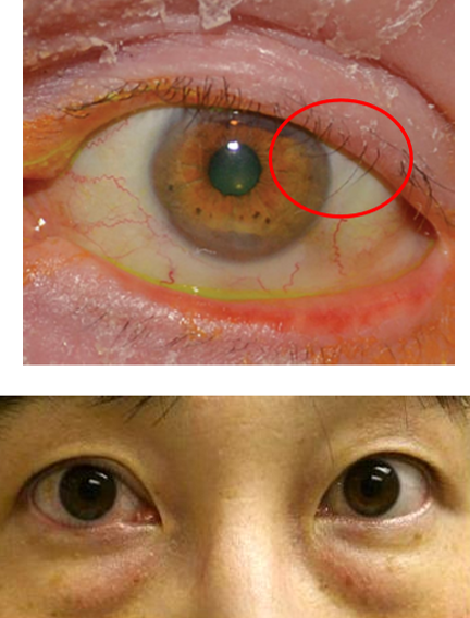 <p>What type of <strong>entropion</strong> is this?</p>