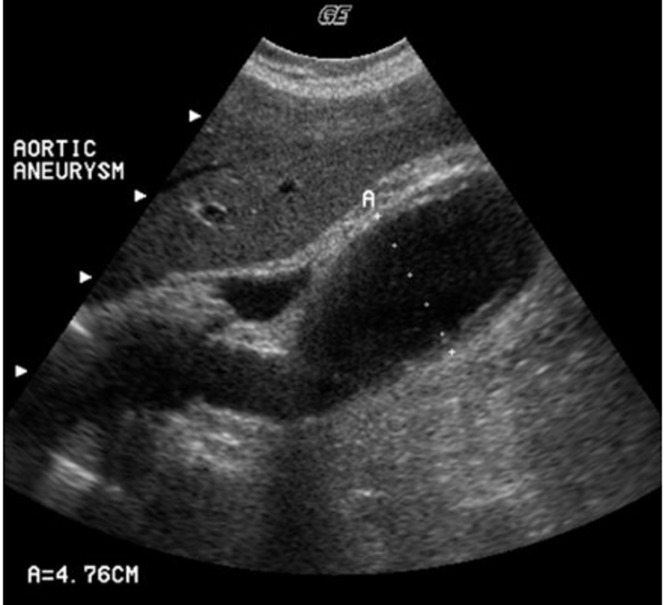 <p>You are asked to perform a follow-up study on a patient with a known abdominal aortic aneurysm. Which of the following terms correctly describes this aneurysm?</p><p>a. pseudoaneurysm</p><p>b. saccular</p><p>c. dissecting</p><p>d. fusiform</p><p>e. dumbbell</p>