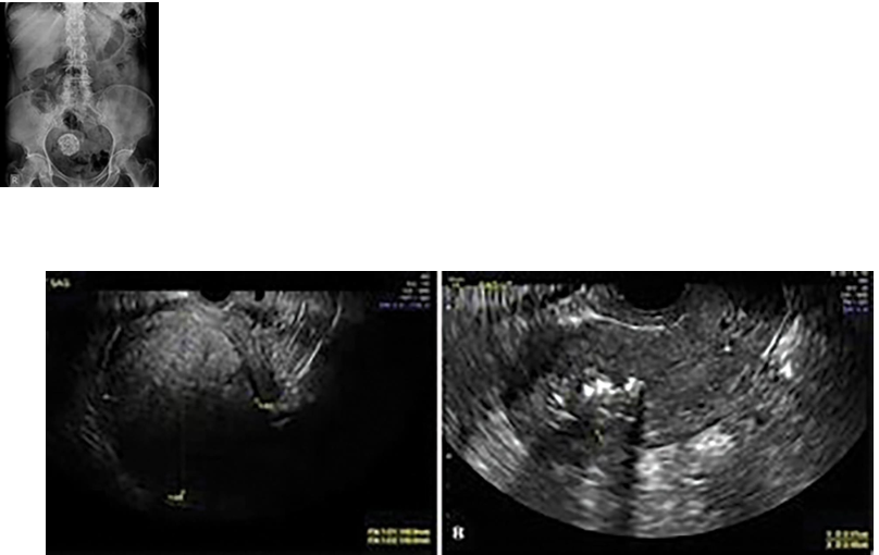 <p>Uterine Calcifications</p>