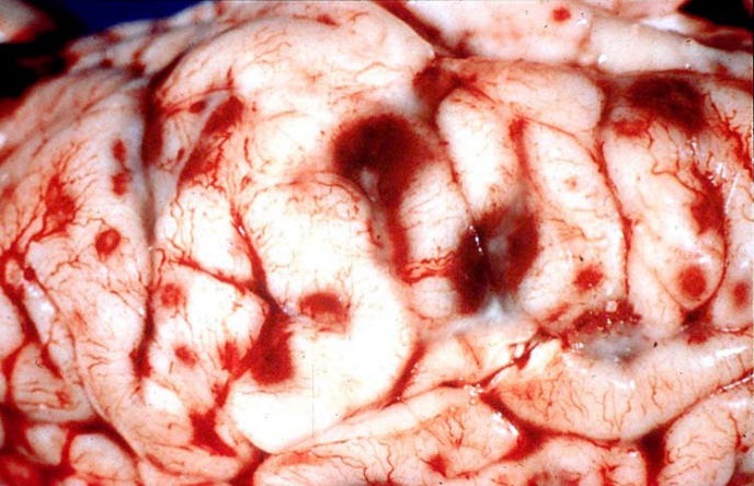 <p>infarction → thrombotic meningoencephalitis (TME)</p>