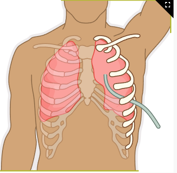 <p>Chest Tube Insertion Complication</p>