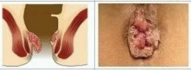 <p>Which grade of internal hemorrhoids has painless bleeding and perianal itching and on exam you find that the hemorrhoid prolapses with straining but <strong>reduces spontaneously</strong>?</p>