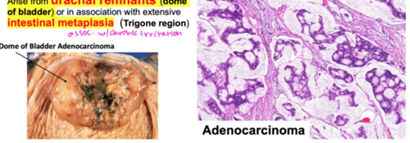 <p>Multiple tumors, often malignant --> metastasizes to pelvic lymph nodes, liver, and bone</p>