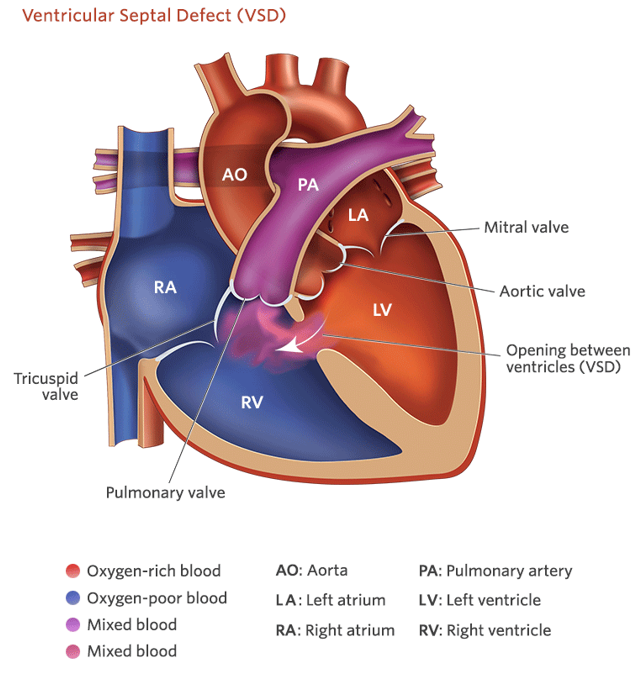 <p><strong><u>Increased</u> Pulmonary Blood Flow</strong></p><ul><li><p class="">The most common congenital heart defect!</p></li><li><p class="">Hole in the wall between the left and right ventricles.</p></li><li><p class="">Asymptomatic if small.</p></li><li><p class="">Left to right shunt.</p></li><li><p class="">Loud, harsh holosystolic murmur—rapid heartbeat. (can hear without stethoscope)</p></li><li><p class="">Increased flow to lungs leading to pulmonary hypertension.</p></li><li><p class="">Heart failure if not repaired.</p></li><li><p class="">Failure to thrive (FTT).</p></li></ul><p></p>