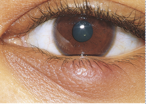 <p>Obstruction of Meiobmain gland. Points inside the eyelid not out. </p>