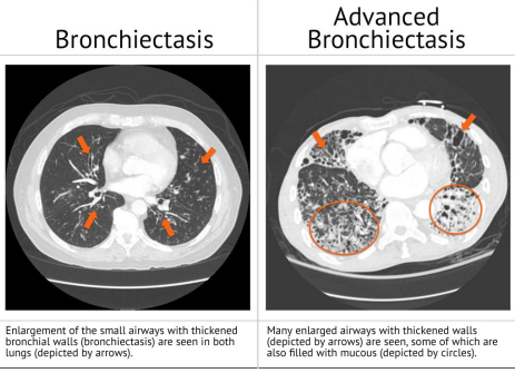 <p><strong>Bronchiectasis Diagnosis</strong></p><p>-CXR: _________, but non-specific with linear atelectasis, tram-track appearance, __________, and increased bronchial markings </p><p>-High-resolution CT (____) scan: gold standard for __________. Shows bronchial ________, thickened airway walls, and lack of tapering </p><p>-PFTs: often show __________ pattern, decreased FEV1/ratio/FVC</p><p>-Sputum cultures: identify ____________ colonization (e.g., Pseudomonas)</p><p>-Bronchoscopy: used in select cases to rule out obstruction or malignancy</p><p>-Workup for __________ conditions: immunoglobulin levels, CFTR genetic testing, and ciliary function testing</p>