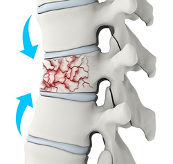 <p>What type of fracture is characterized by the bone being crushed and is common in porous bones of older people. \n A) comminuted</p><p>B) green stick</p><p>C) compression</p><p>D) spiral</p><p>E) impacted</p>