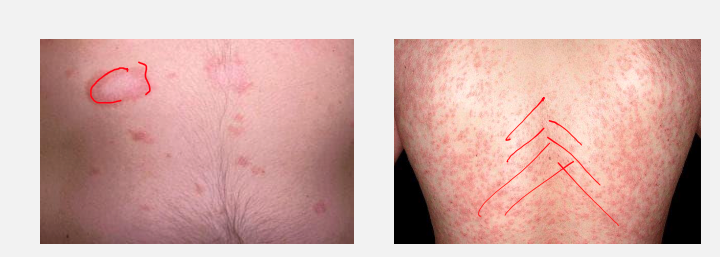 <ul><li><p><strong>Pruritus</strong> (itching) is mild in most but <strong>severe in ~25%</strong> of patients.</p></li><li><p><strong>Rash and Herald patch last 6–12 weeks.</strong></p></li><li><p>Self-resolves without scarring.</p></li></ul><p></p>