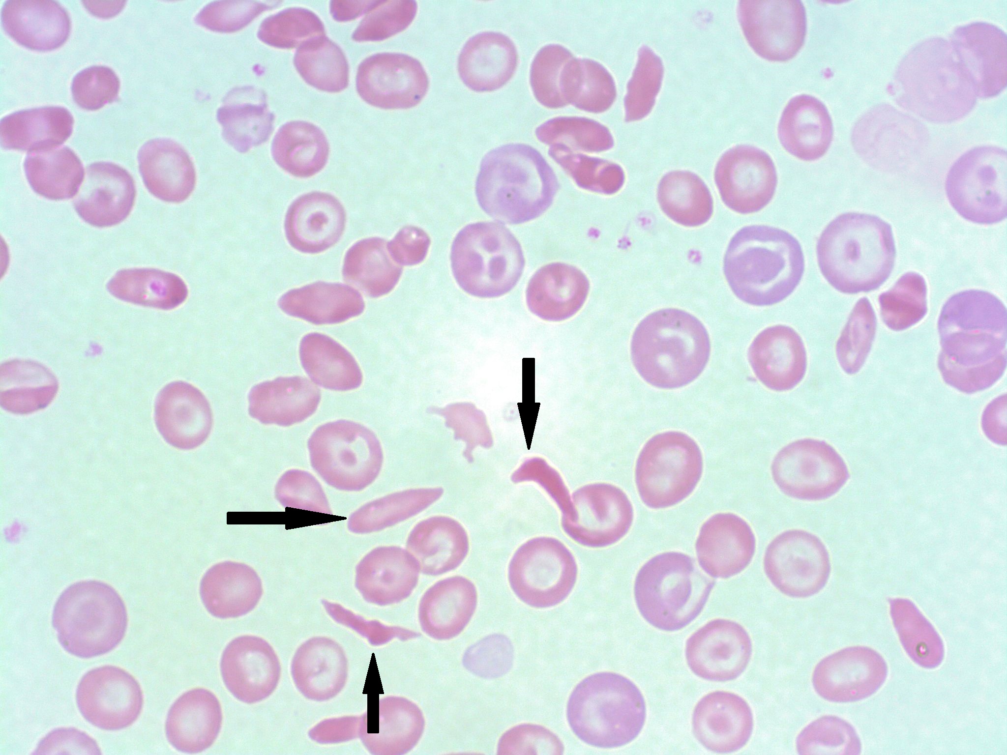 What disease is shown here?