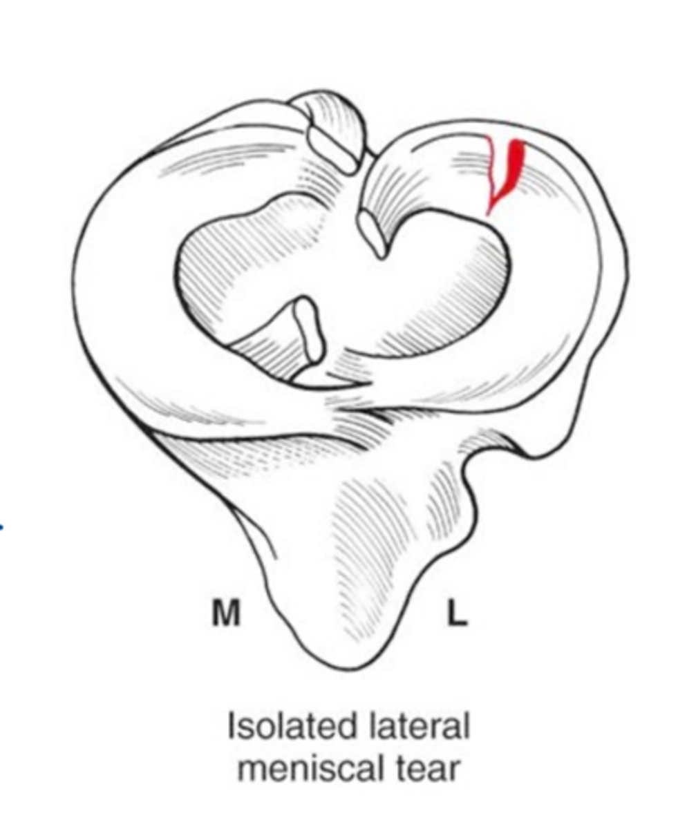 <p>what makes isolated lateral meniscal tears RARE</p>