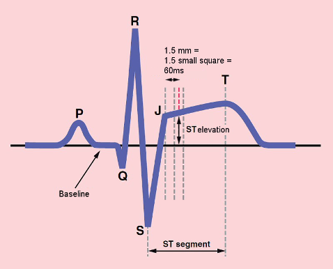 <ul><li><p>Diagnosis based on 3 findings:</p><ul><li><p>Clinical presentation</p></li><li><p>Serial 12-lead ECG’s</p><ul><li><p>Earliest findings in areas of ECG representing repolarization</p></li></ul></li><li><p>Lab findings: cardiac enzymes</p></li></ul></li><li><p>Heart attack is suspects - reperfution (best within 90 mins+)</p></li><li><p>Troponin = heart attack</p></li></ul><p></p>