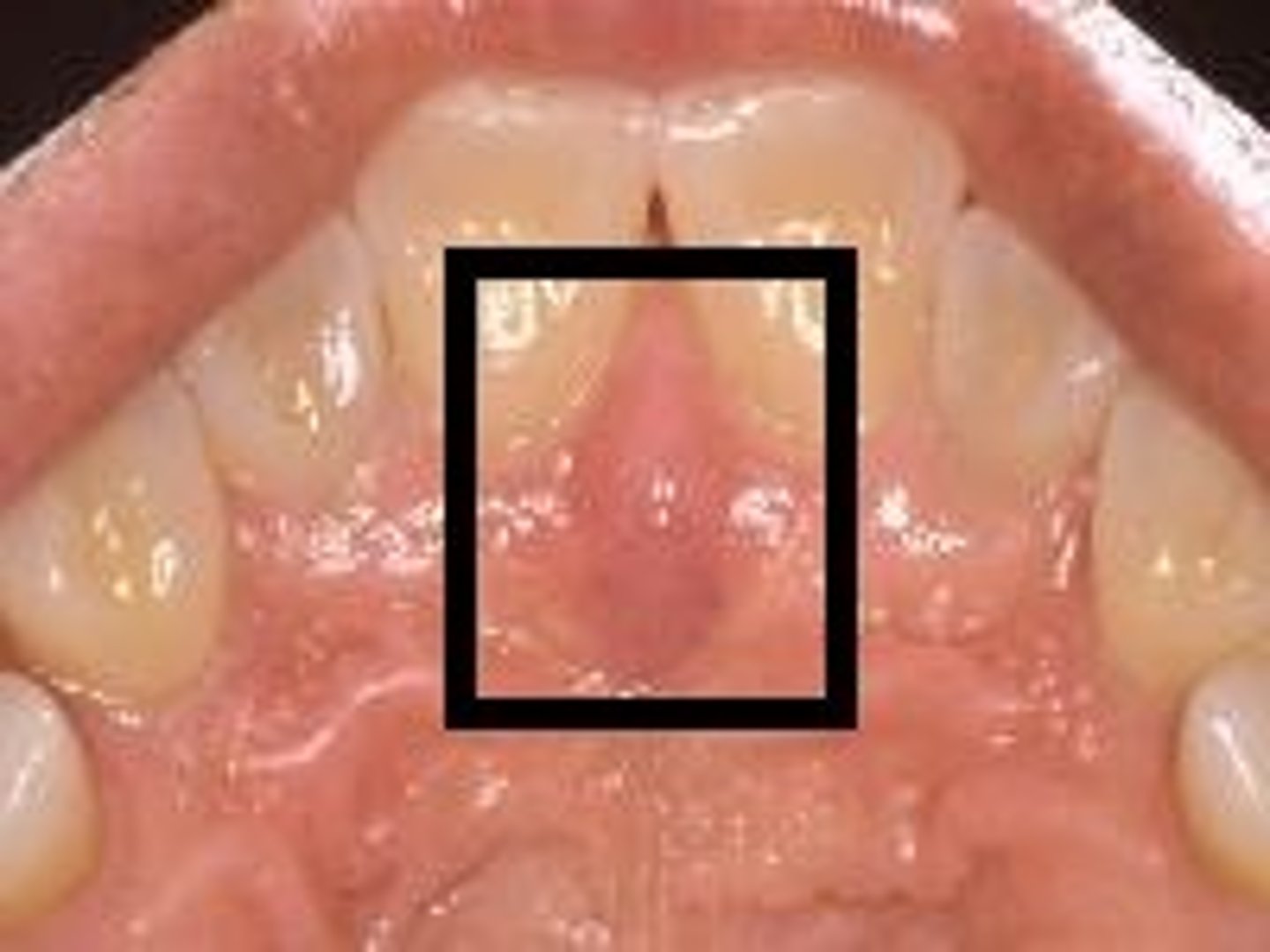 <p>Bulge of tissue at the midline behind the maxillary central incisors.</p>
