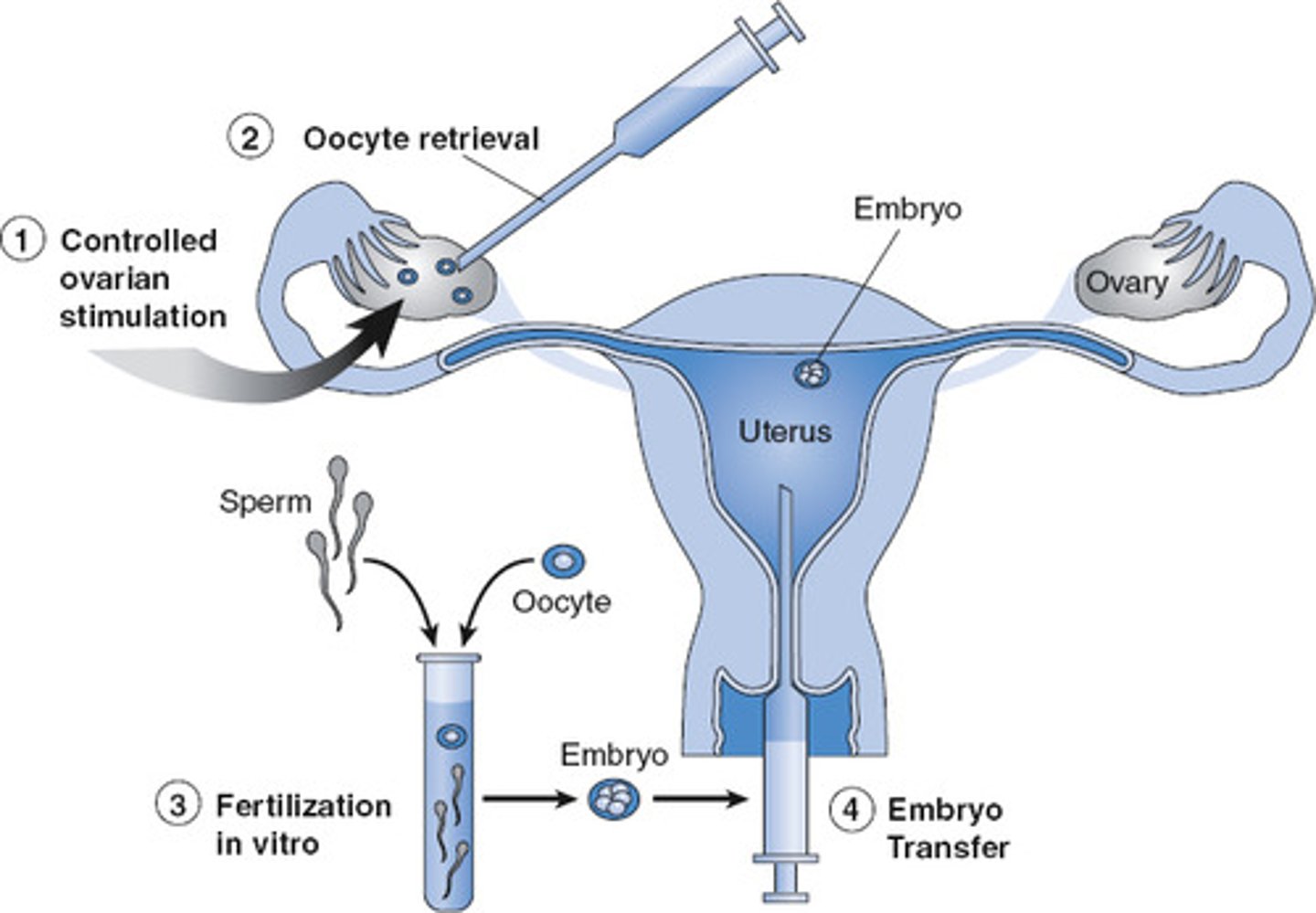 <p>IVF (in vitro fertilization)</p>
