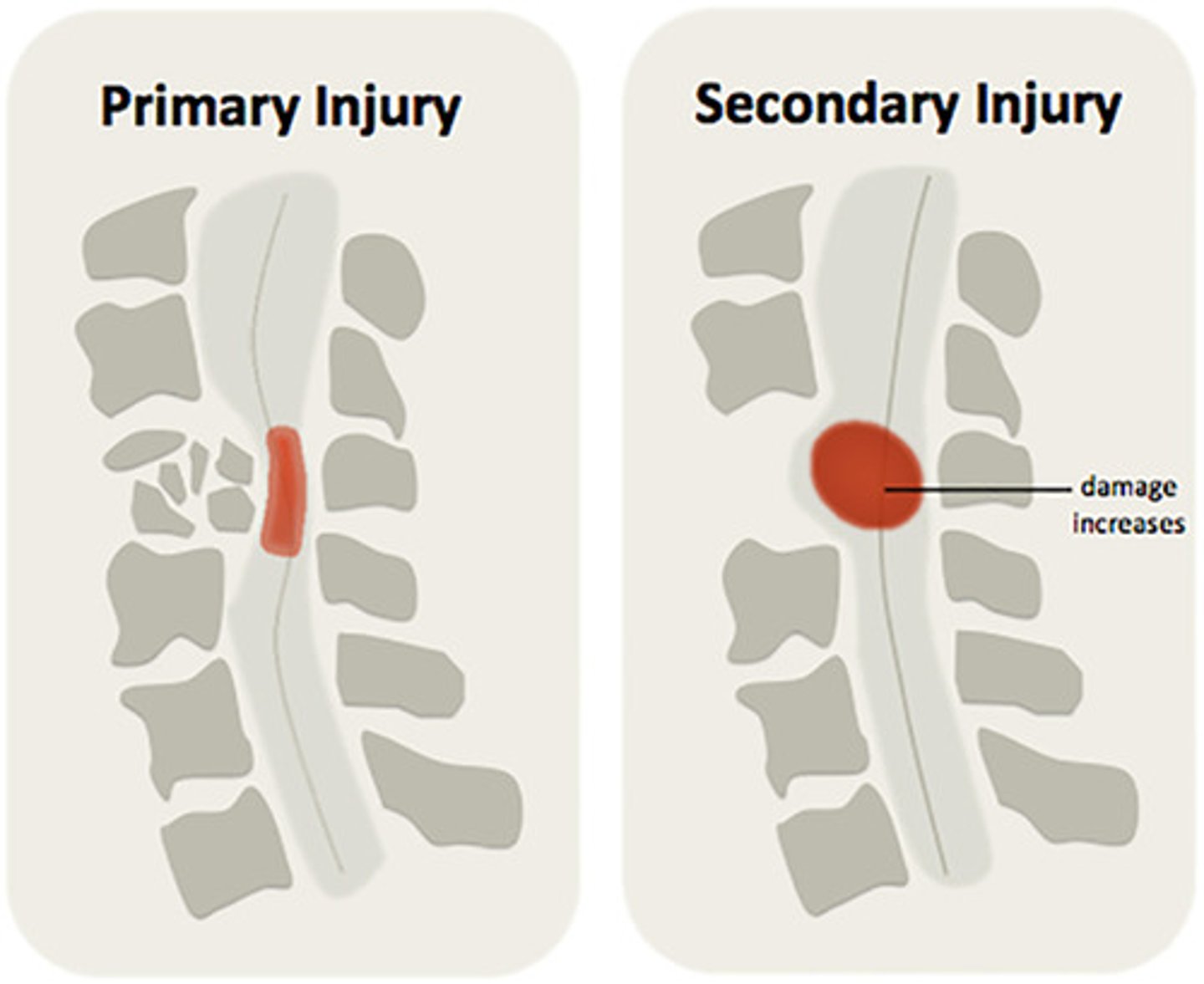 <p>brain damage that occurs as a response to the initial injury. ex: hematoma, hypoxia, ischemia, increased intracranial pressure, and post-traumatic epilepsy</p>