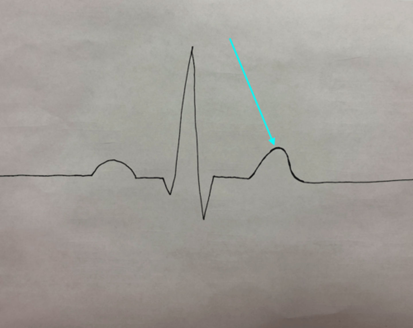 <p>What feature of an ECG is the blue arrow pointing at?</p>