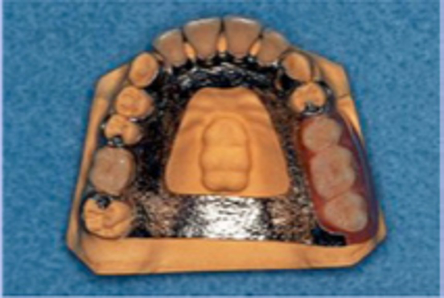 <p>Coverage of palatal tori should be avoided if possible.</p><p>The tissue covering tori is thin and susceptible to irritation</p>