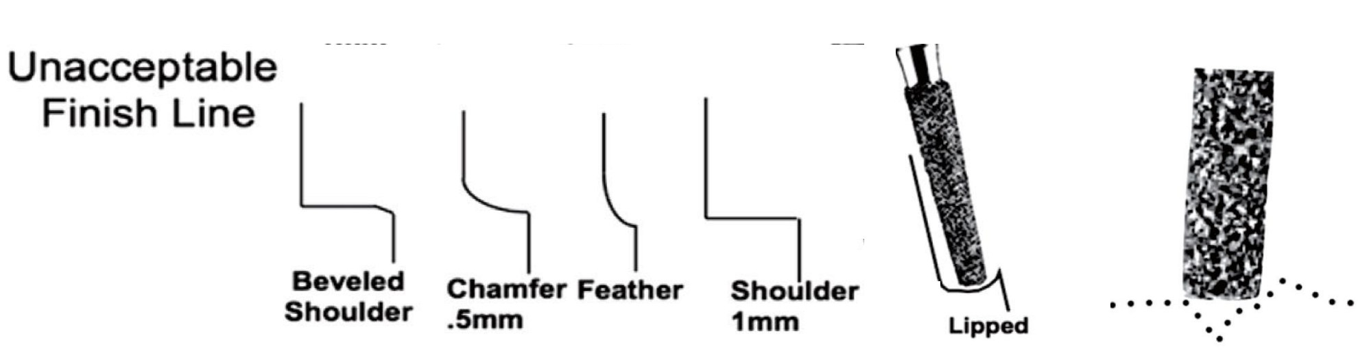 <ul><li><p>beveled shoulder </p></li><li><p>chamfer .5 </p></li><li><p>feather </p></li><li><p>shoulder 1 mm </p></li><li><p>lipped </p></li></ul><p></p>
