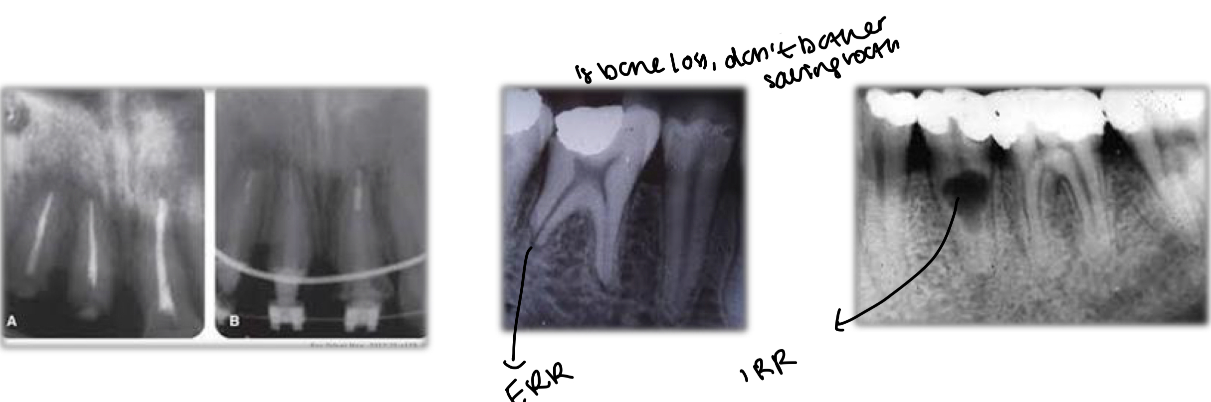 <p>No cavities, fractures or resorption</p><p>Enough length and thickness</p><p>Straight root, round wide canal</p><p>In multi radicular teeth- choose thickest, longest most straight root</p>