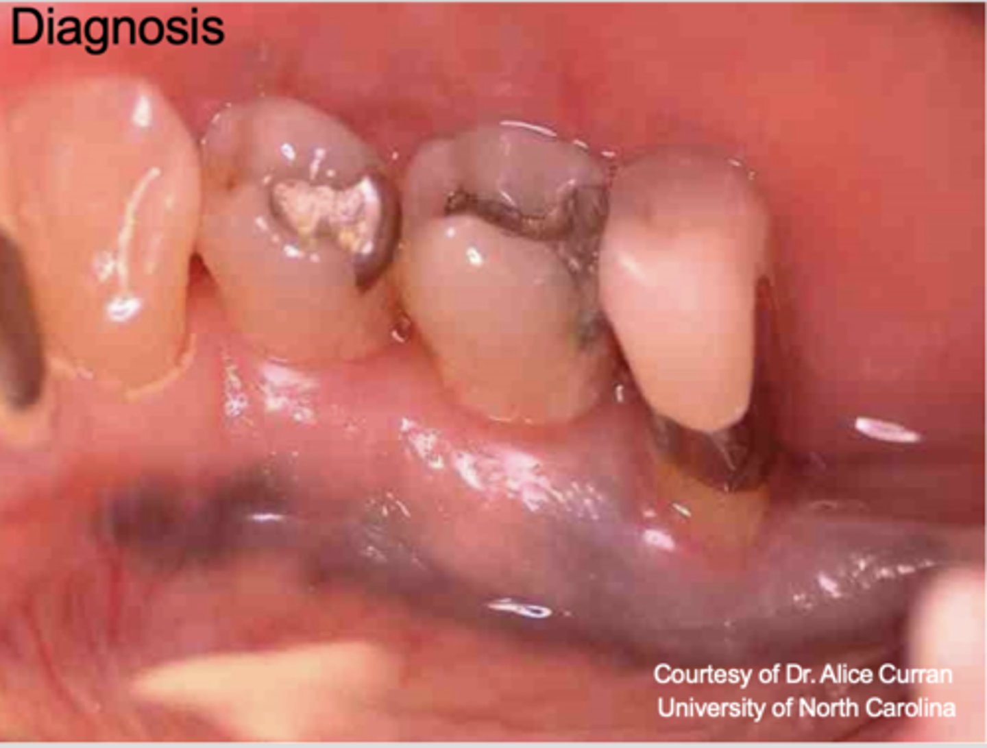 <p>What type of pigmented lesion?</p>