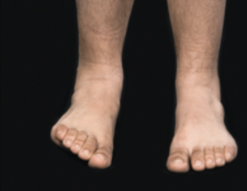 Turning the sole (plantar surface) of foot laterally