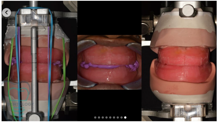 <ul><li><p>Aumentan la precisión oclusal. </p></li><li><p>Mejoran la estabilidad de la prótesis total.&nbsp;</p></li><li><p>Reducen tiempos de ajuste clínico.&nbsp;</p></li><li><p>Mejoran estética y función.&nbsp;</p></li><li><p>Disminuyen errores acumulativos durante las fases posteriores.</p></li></ul><p></p>