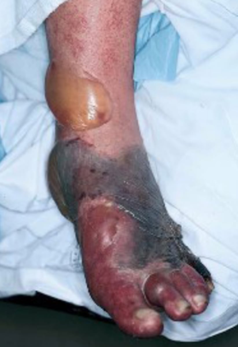 <p>clostridium (tissues not just cells; release gas into tissues)</p>