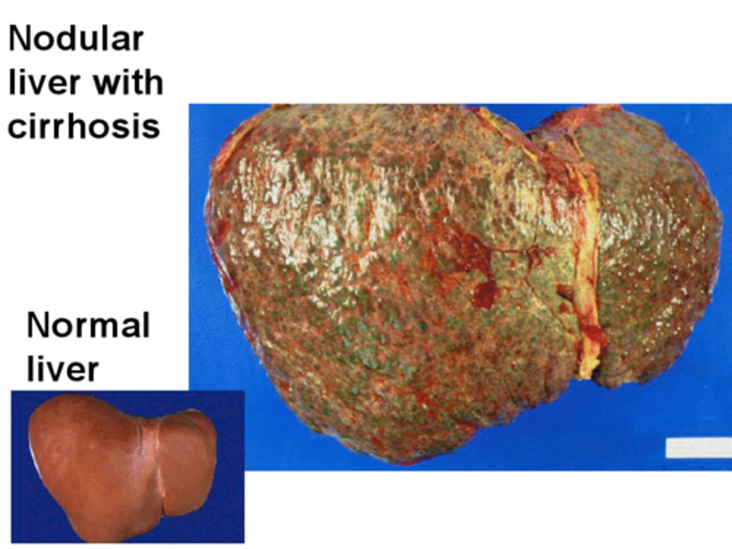 <p>Enlarged firm, hard, nodular liver suggests cancer. Other causes may be late cirrhosis or syphilis.</p>