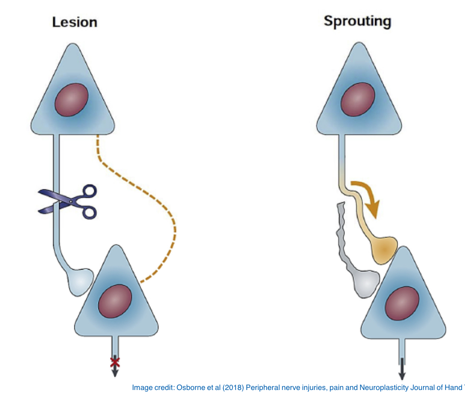 <p>The attempt of <strong><em><u>damaged</u></em></strong> axons to re-establish connection with the damaged tissue</p>