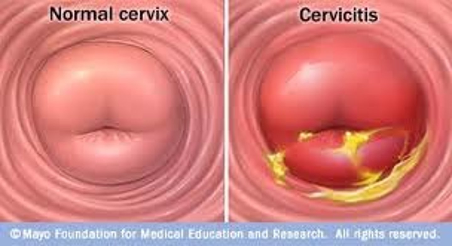 <p>inflammation of the cervix</p>