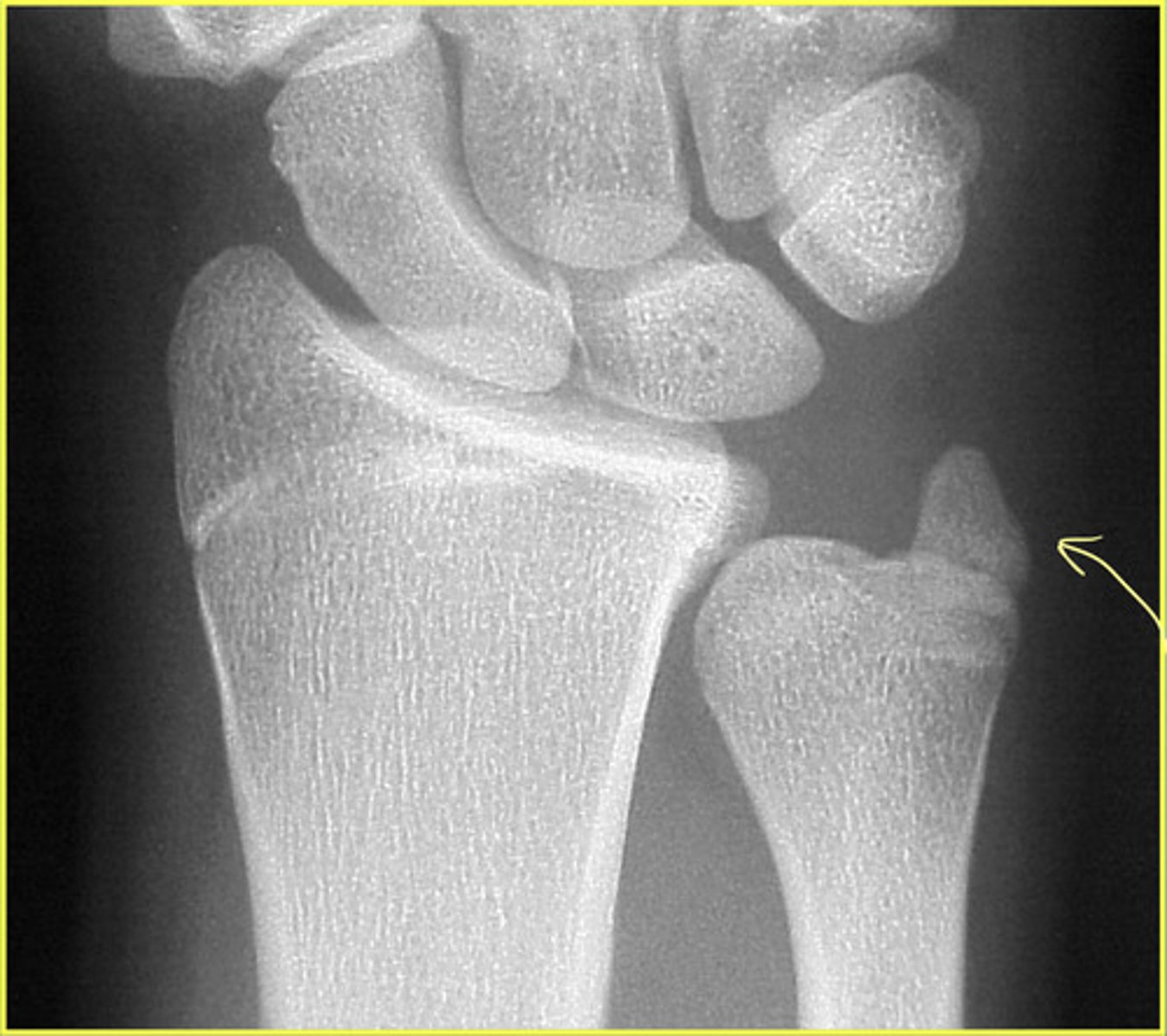 <p>Another persistent apophysis</p>