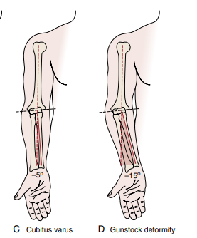 <p>Cubitus Varus / Gunstock deformity (more severe varus dt trauma)</p>