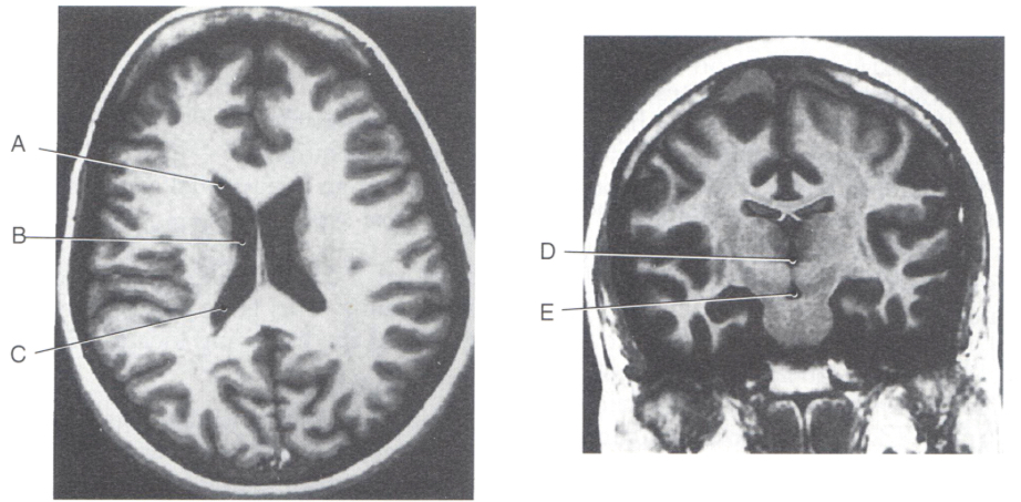 <p>PI: a 43 y/o woman presents with headache and signs of increased ICP. MRI reveals a tumor in the body of the lateral ventricle. which of the following labeled areas most closely represents this part of the ventricular system?</p><ol><li><p>A</p></li><li><p>B</p></li><li><p>C</p></li><li><p>D</p></li><li><p>E</p></li></ol>