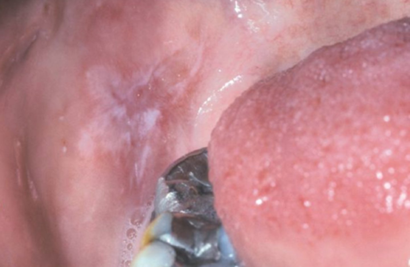 <p>PAINFUL</p><p>• red, edematous area with ulceration or white striae (lichenoid)</p><p>• type 4 allergic rxn</p><p>• EX: cinnamon stomatitis</p>