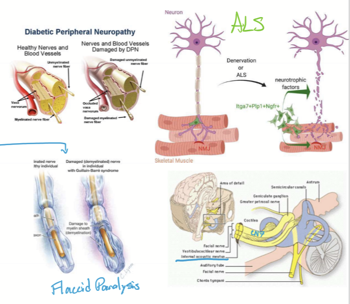 <ul><li><p>traumatic denervation (wallerian degeneration) </p></li><li><p>Diabetic neuropathy</p></li><li><p>Guiallain Barre</p></li><li><p>Amyotrophic lateral sclerosis </p></li><li><p>Polio</p></li><li><p>Bell Palsy </p></li><li><p>Herpes zoster oticus (Ramsay Hunt Syndrome) </p></li></ul><p></p>