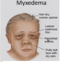 form of cutaneous and dermal edema due to increased deposition of CT 