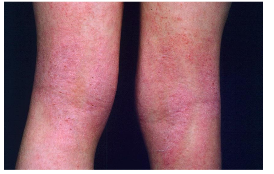 <p>This is a <mark data-color="#beffcd" style="background-color: rgb(190, 255, 205); color: inherit;">pruritic </mark><strong>inflammatory </strong>condition associated with<strong> dryness and erythema of skin</strong>. Scratching results in <strong>excoriation and lichenification</strong></p><p><strong>is aka dermatitis </strong></p><p><strong>image - flexural eczema</strong></p>