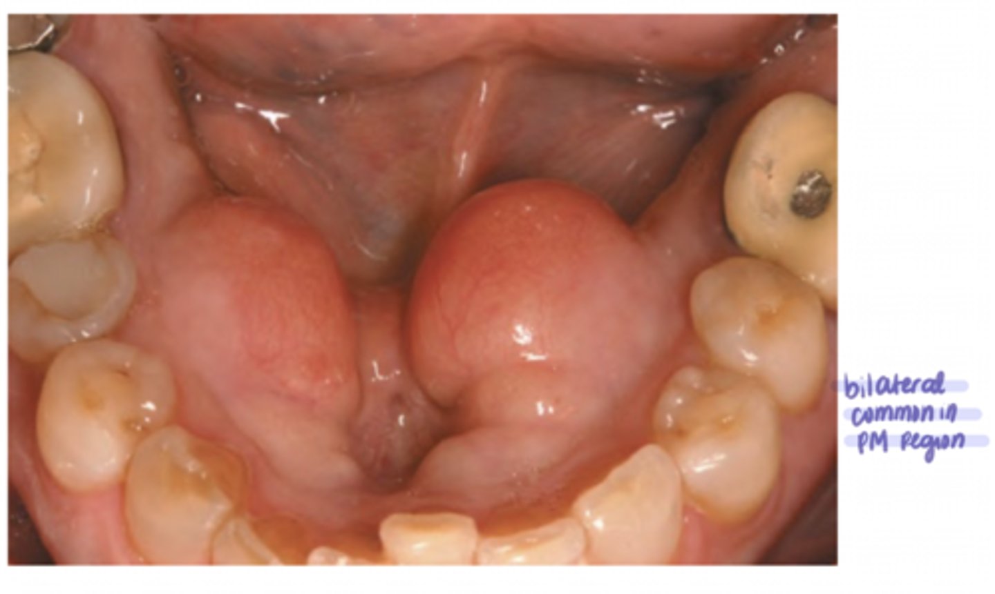 <p>both are true</p><p>bilateral (>90%)</p>