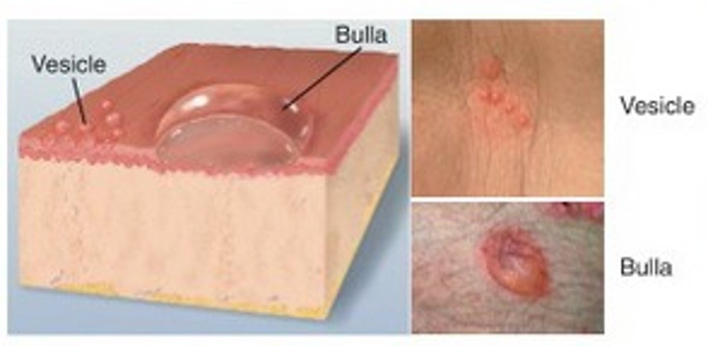 <p>Elevated &lt; 1 cm; a "blister", clear serum flows if wall is ruptured ex. herpes simplex, chickenpox, shingles</p>