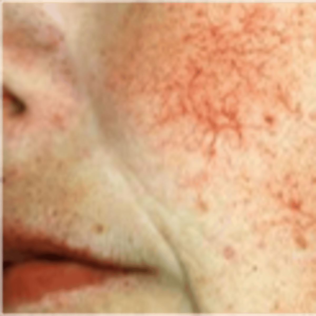 <p>Fine, irregular blood vessels</p>