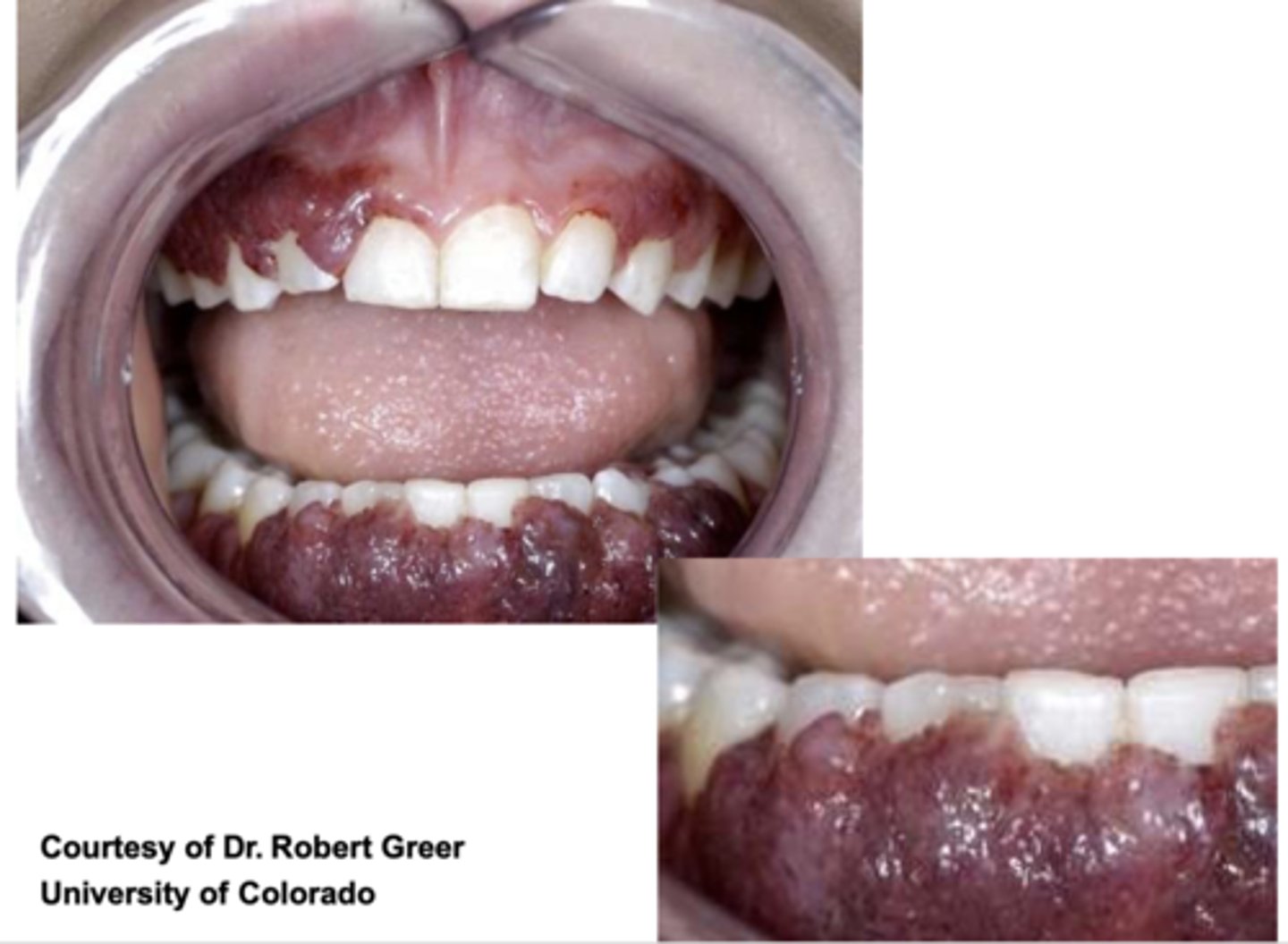 <p>Pulmonary Vasculitis</p>