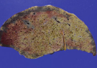 <p>Type of gangrenous necrosis and explain how it occurs and its gross features.</p>