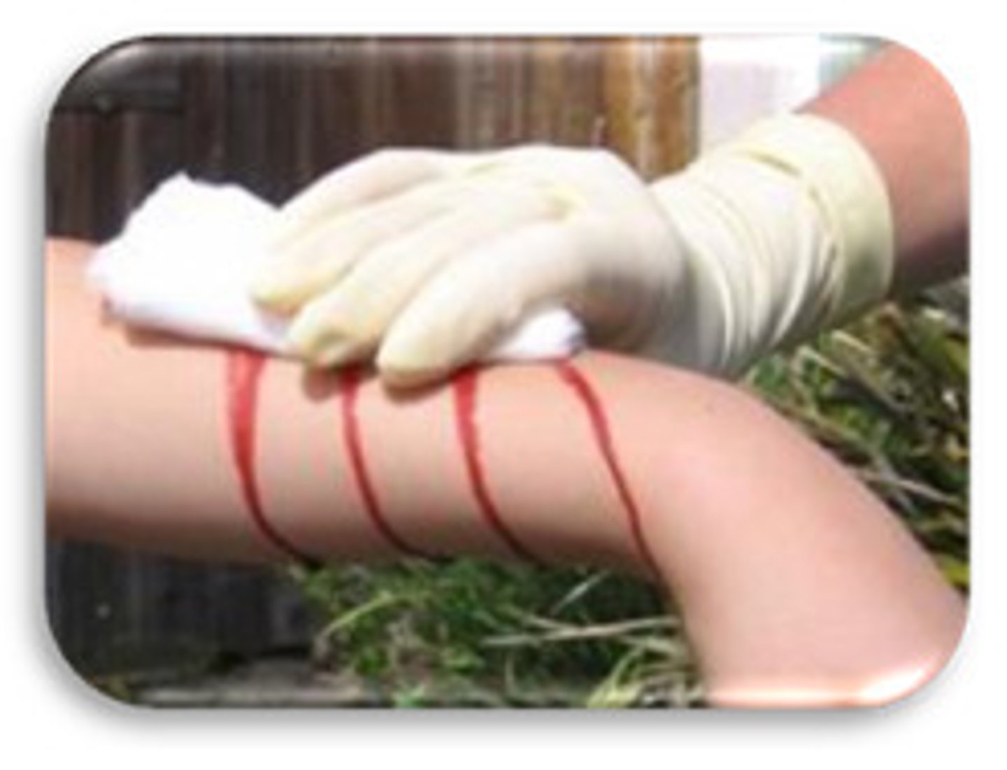 <p>bleeding at the body surface that results from open wounds, such as cuts</p>