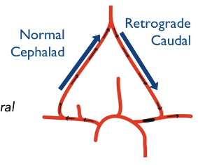 <p>Stenosis of Ipsilateral Prox Subclavian or Brachiocephalic. Pre-Steal.</p>