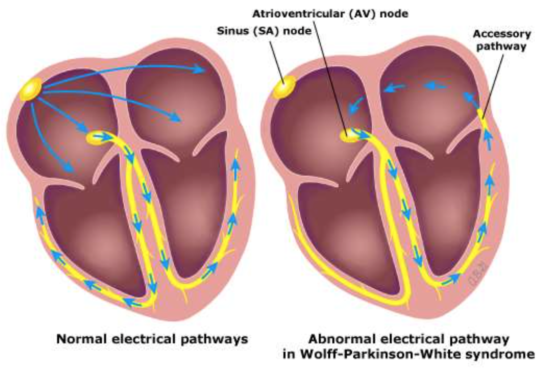 aka WDW

* extra pathway from AV node to accessory pathway -→ causes extra heartbeat
* treat with radiofrequency ablation
  * Catheter into heart, zap the accessory pathway to kill it, no conduction further