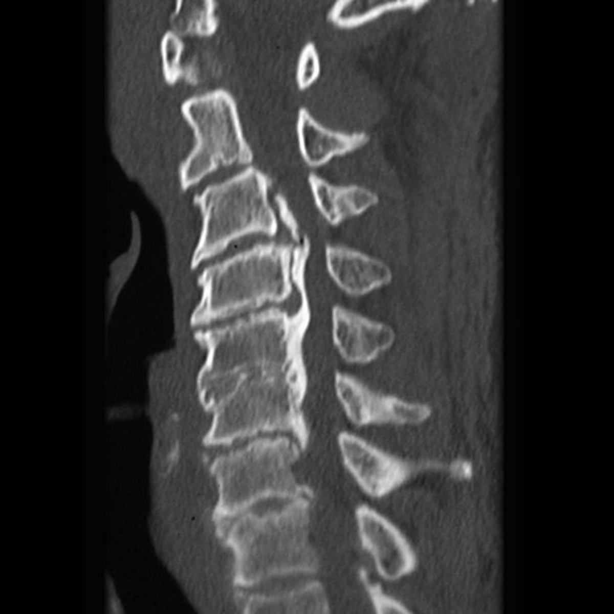 <p>What is the main finding on the CT study?</p>
