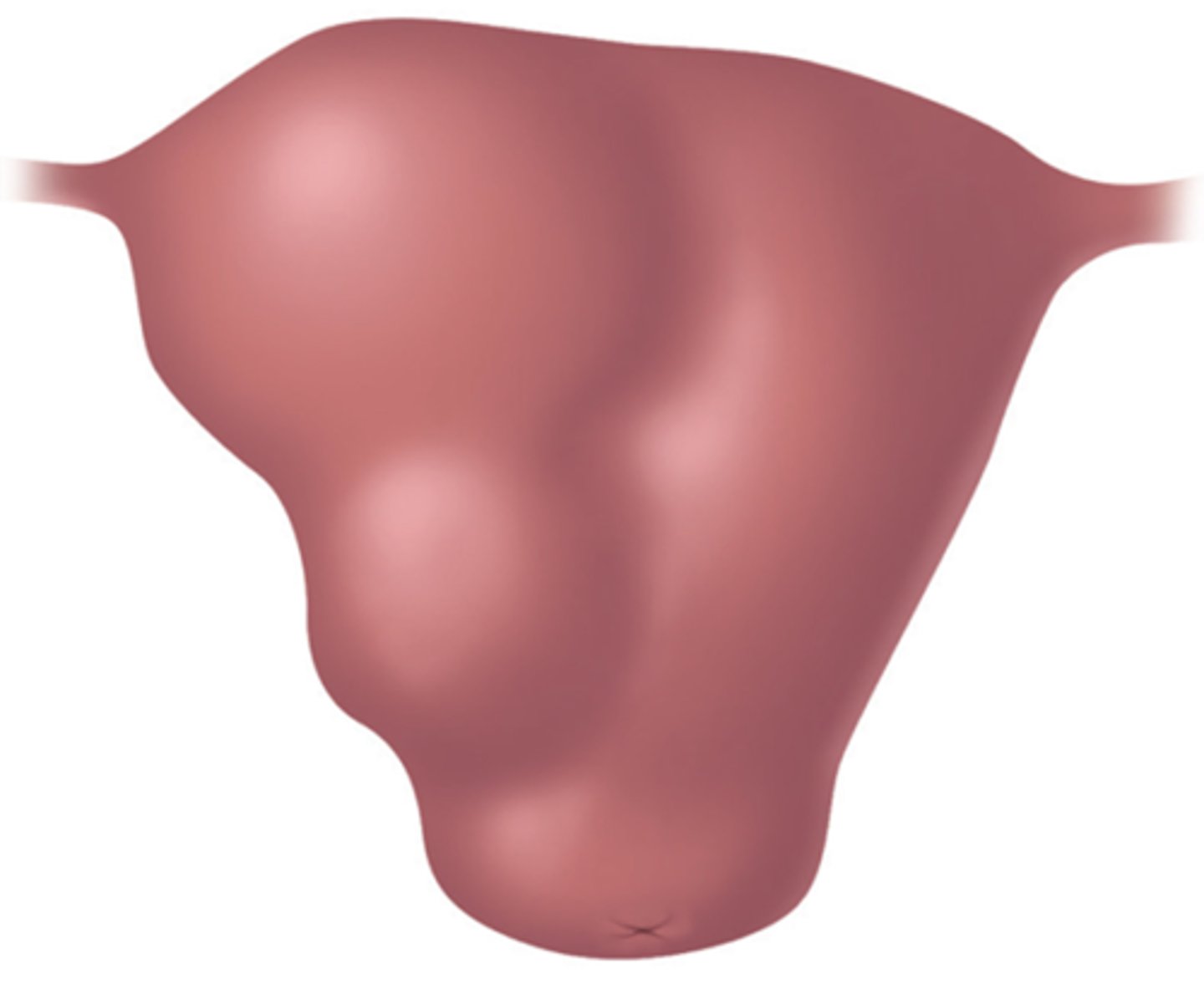 <p>asymmetrical enlargement of the uterus</p>