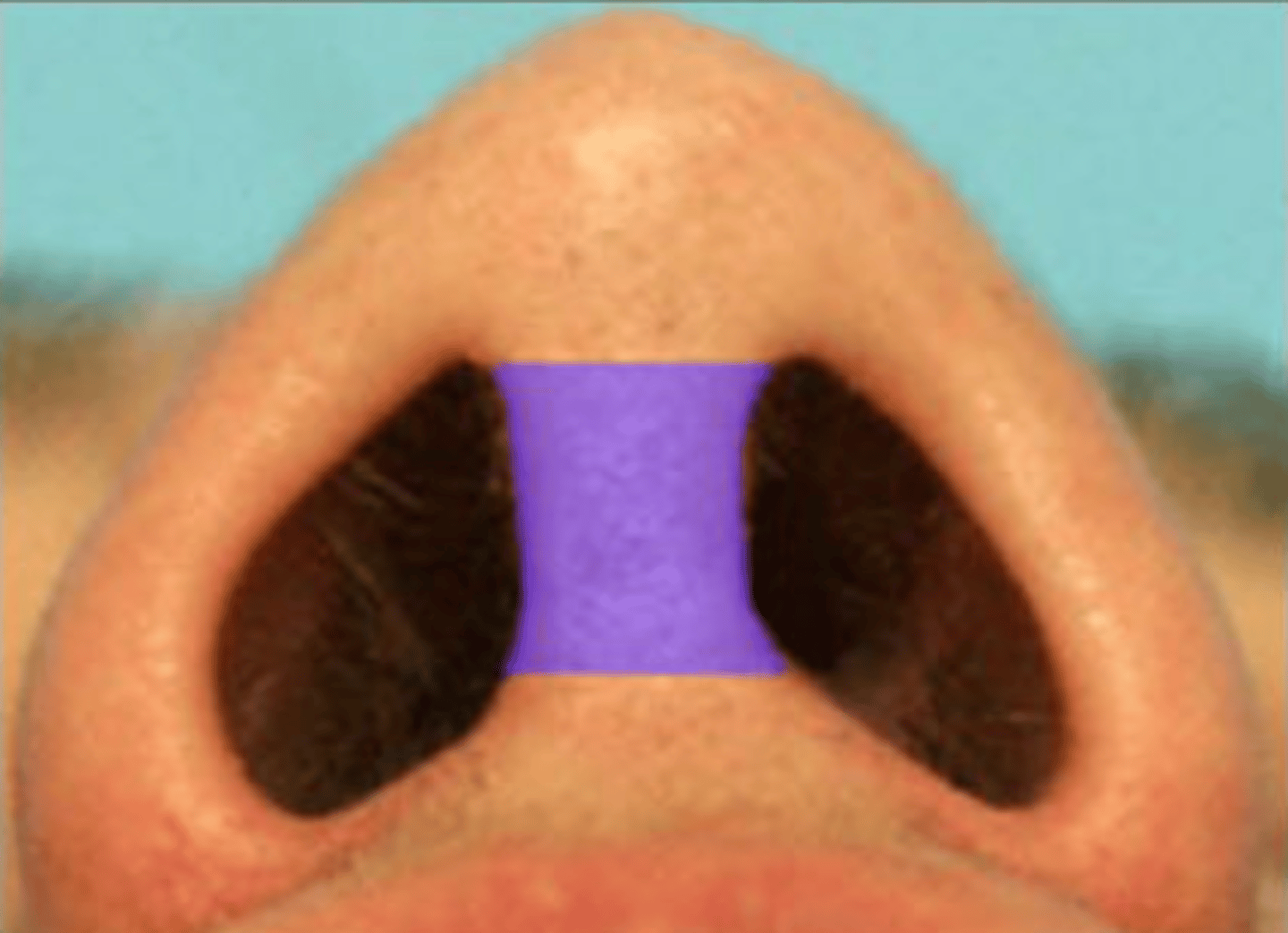 <p>right above philtrum where septum piercing would go </p><ul><li><p>structure</p></li></ul><p></p>