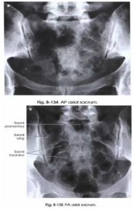 <p><span><strong>PP: </strong>Supine or prone (patient w/painful injury/destructive disease)</span></p><p><span><strong>RP</strong>: 2 in. superior to pubic symphysis (supine); visible sacral curve (prone)</span></p><p><span><strong>CR: </strong>15o cephalad (supine); 15o caudad (prone)</span></p><p><span><strong>SS: </strong>Sacrum free of foreshortening</span></p>