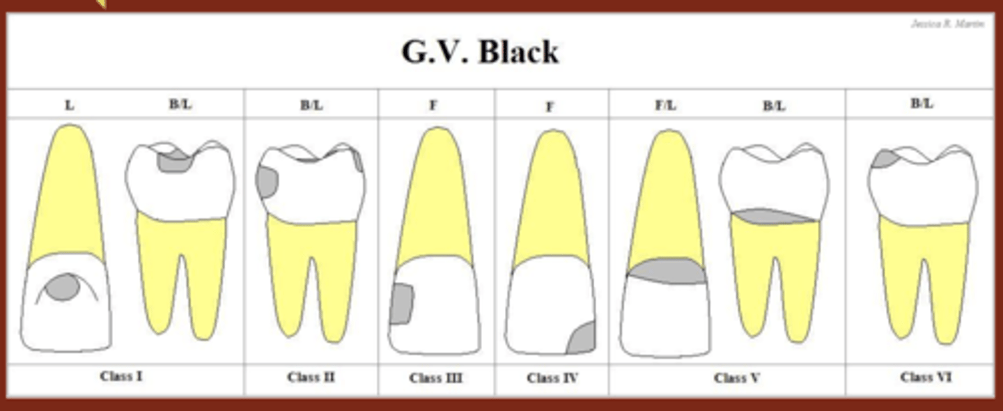 <p>Class 1: pits and fissures (we can do this)</p><p>Class 2: interprox of posterior teeth (we can do this)</p><p>Class 3: interprox of anterior teeth </p><p>Class 4: interprox and incisal edge of anterior teeth </p><p>Class 5: gingival third (gingival margin) (we can do this)</p><p>Class 6: cusp tips</p>