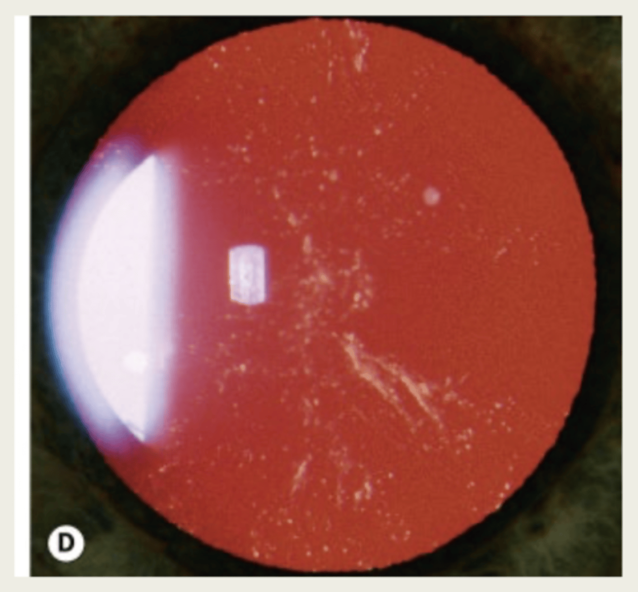 <p>diffuse milky white opacification with snowflake-like opacities - subcapsular!</p>